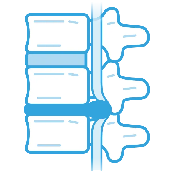 Illustration of a degenerated, bulging disc pressing on the spinal cord