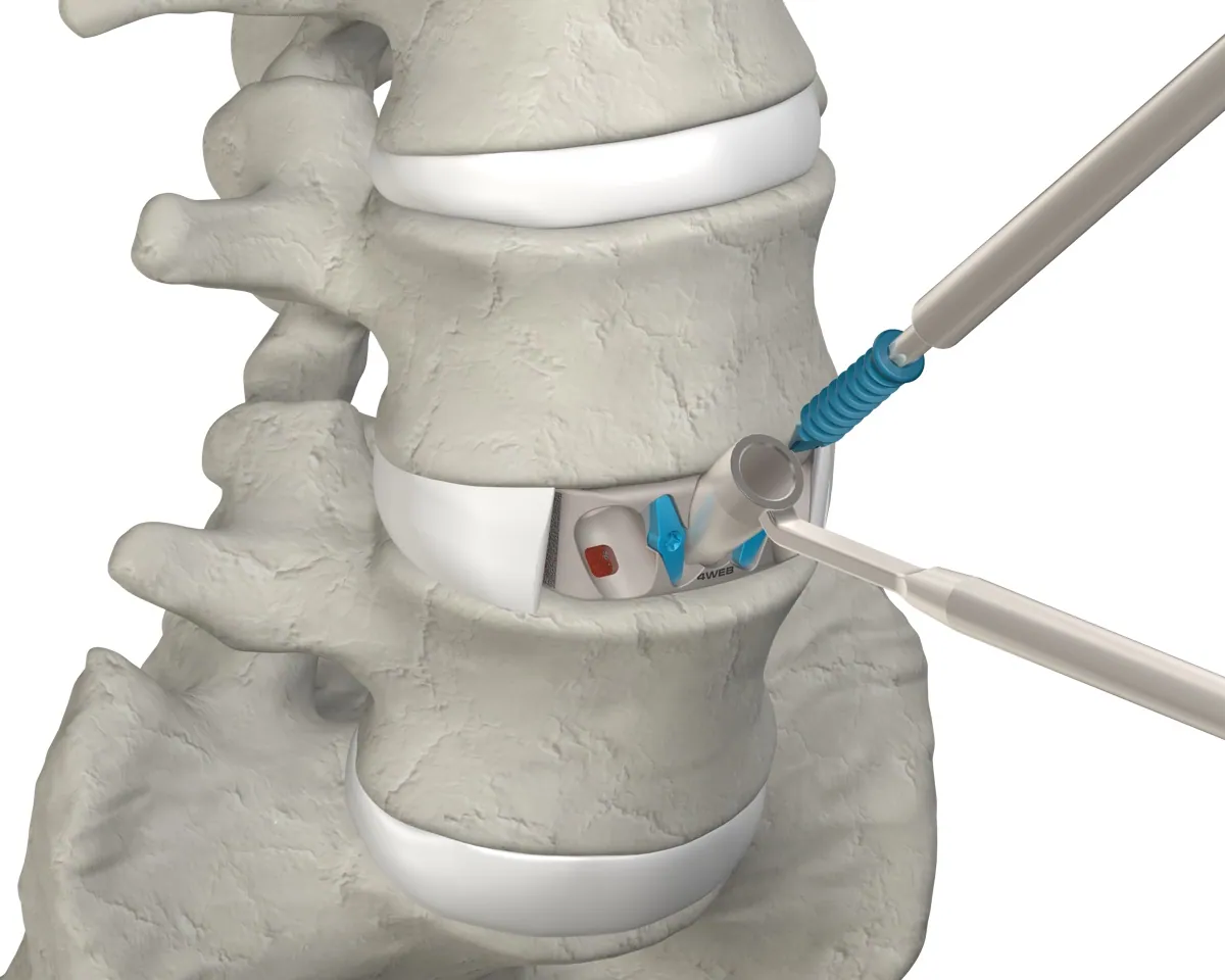 ASTS-SA inserter placing the implant into the disc space