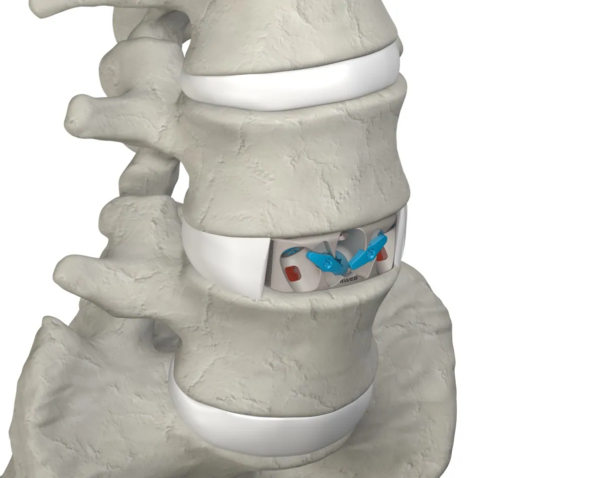 ASTS-SA final implant placed within the anterior spine