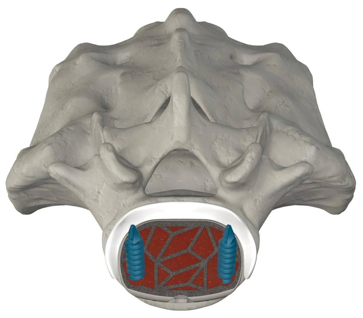 ASTS-SA cage cross-section within the vertebral body