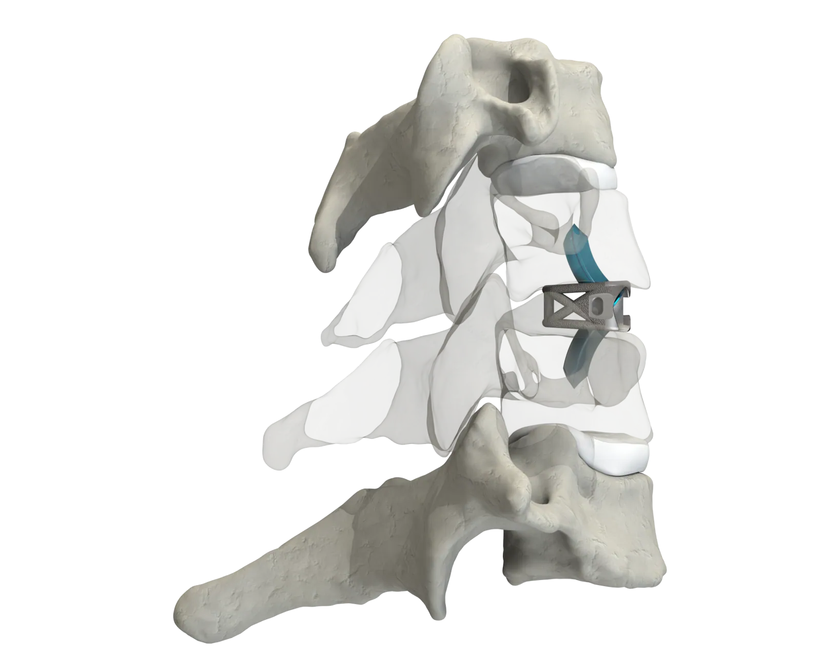 CSTS-SA with Anchor Fixation placed within the cervical spine