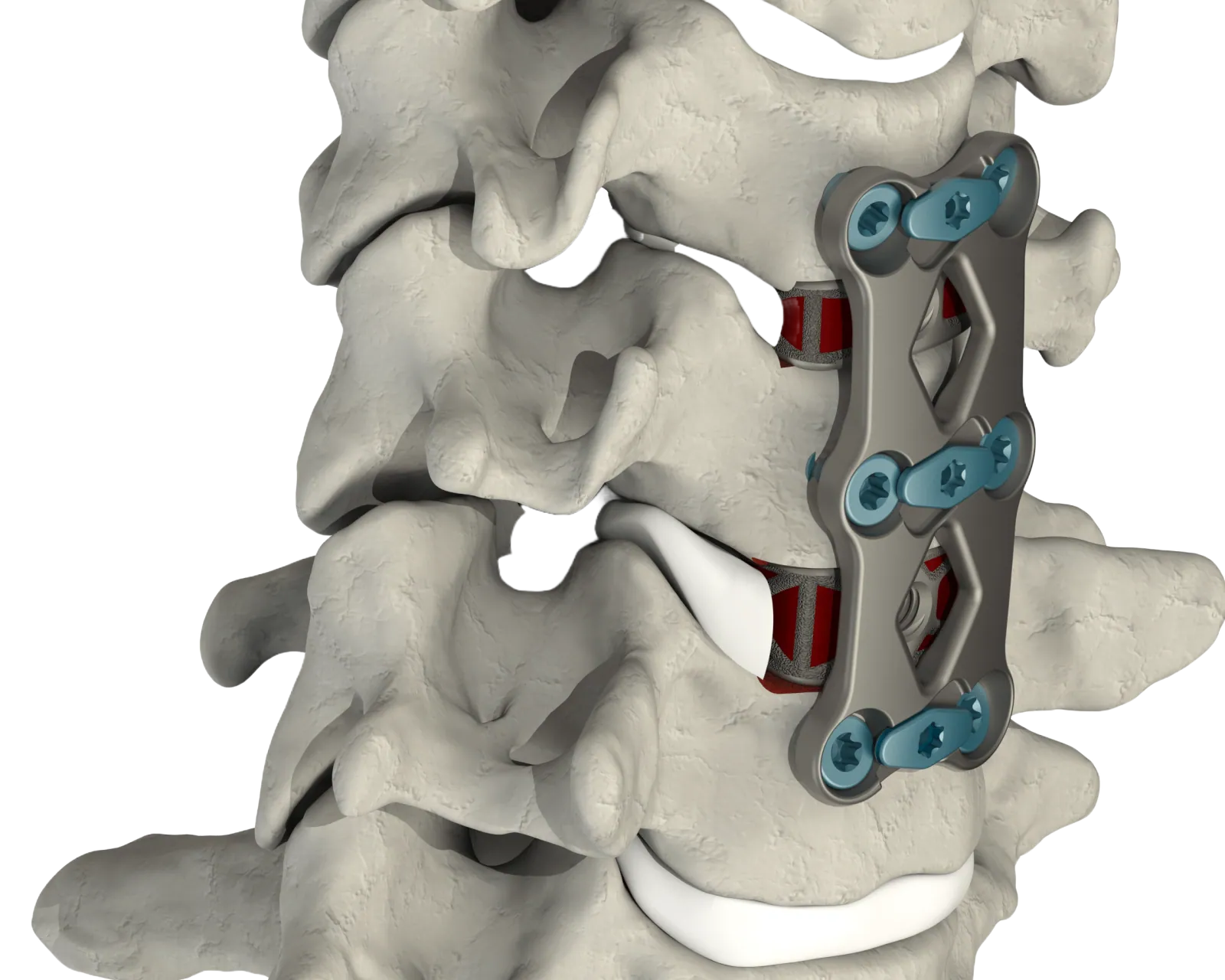 CSTS-PS placed within the cervical spine