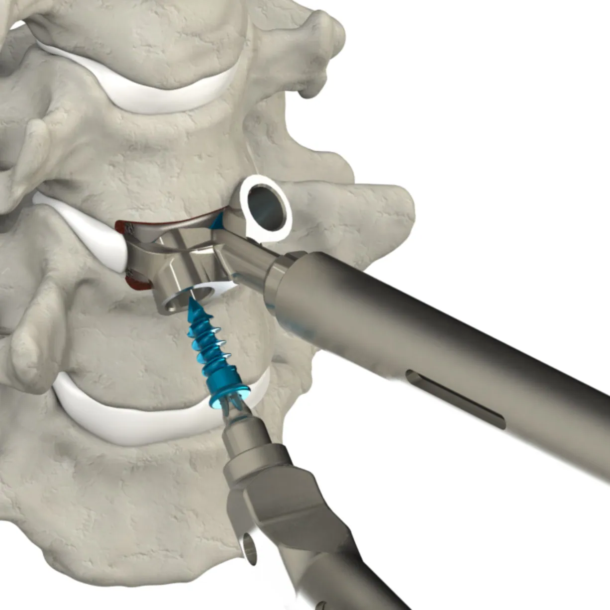 CSTS-SA insertion into the disc space