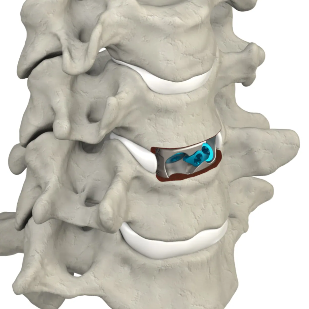 CSTS-SA placed within the cervical spine