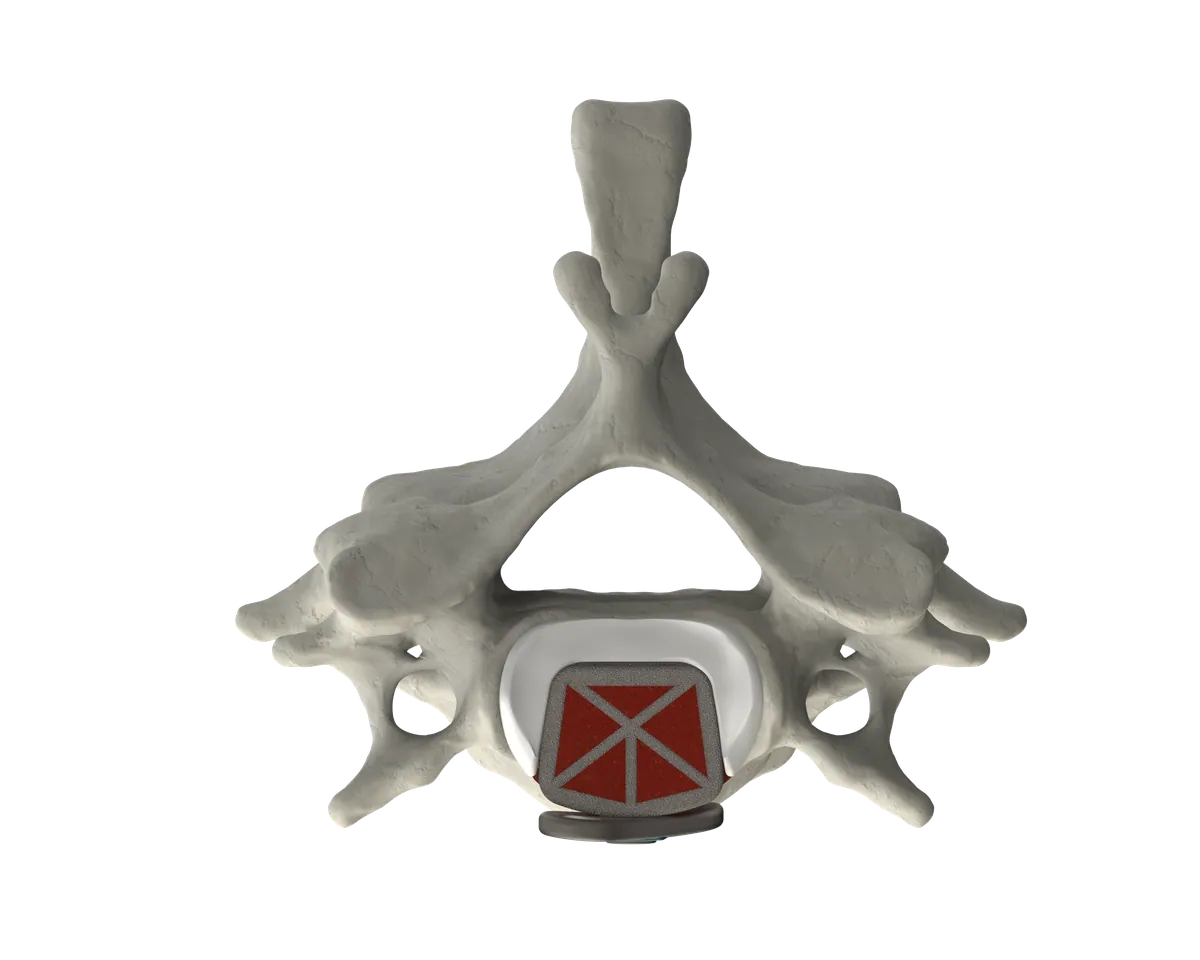 CSTS 2.0 anterior view within the vertebral body