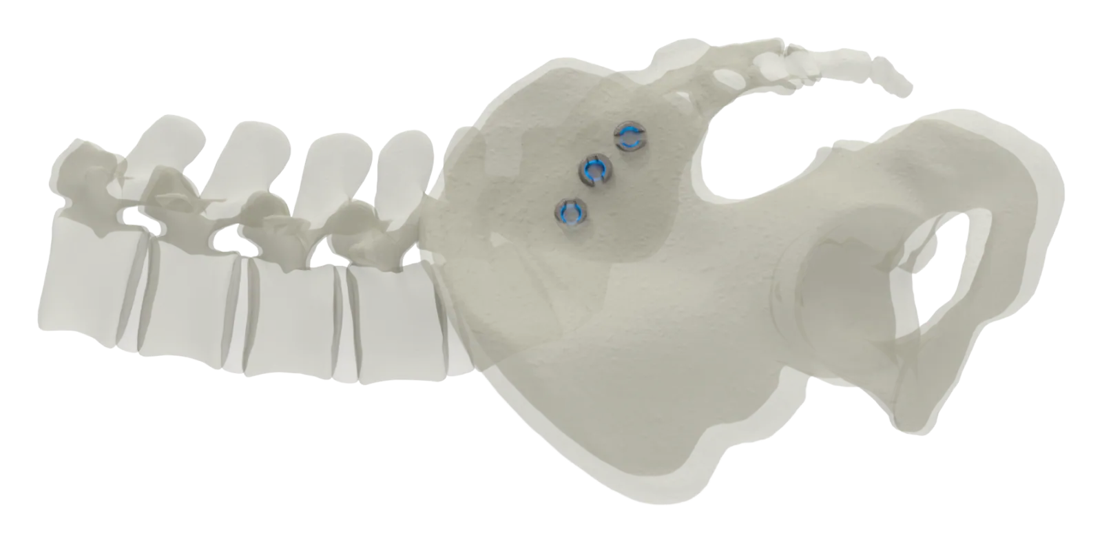 SJTS lateral approach, lateral view of screw placement